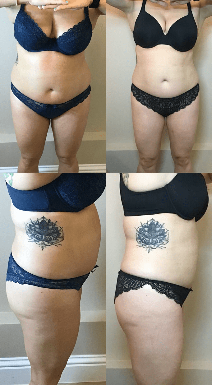 Bodcor Body Contouring Before and After Transformations