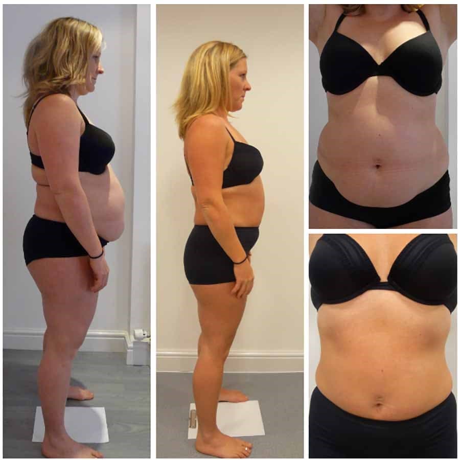 This is a unique, non-invasive, non-surgical treatment that uses a medical grade technology to shape and contour your body 