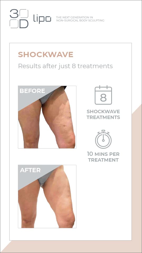 A prescriptive treatment tailored to meet your needs using a combination of 3D Shockwave and 3D radiofrequency is used to reduce cellulite.