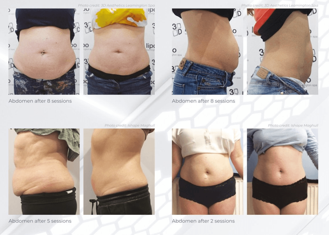 3D Bespoke Concentrated Non Surgical Fat Removal Expert treatment which involves an individual or combined bespoke treatment using 3D-Cavitation, 3D-Radio Frequency and/or 3D-Shockwave. This creates a complete, effective and safe choice for fat reduction. Call 0333 016 3500.