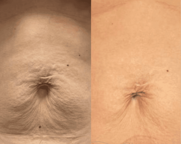 Body Microneedling