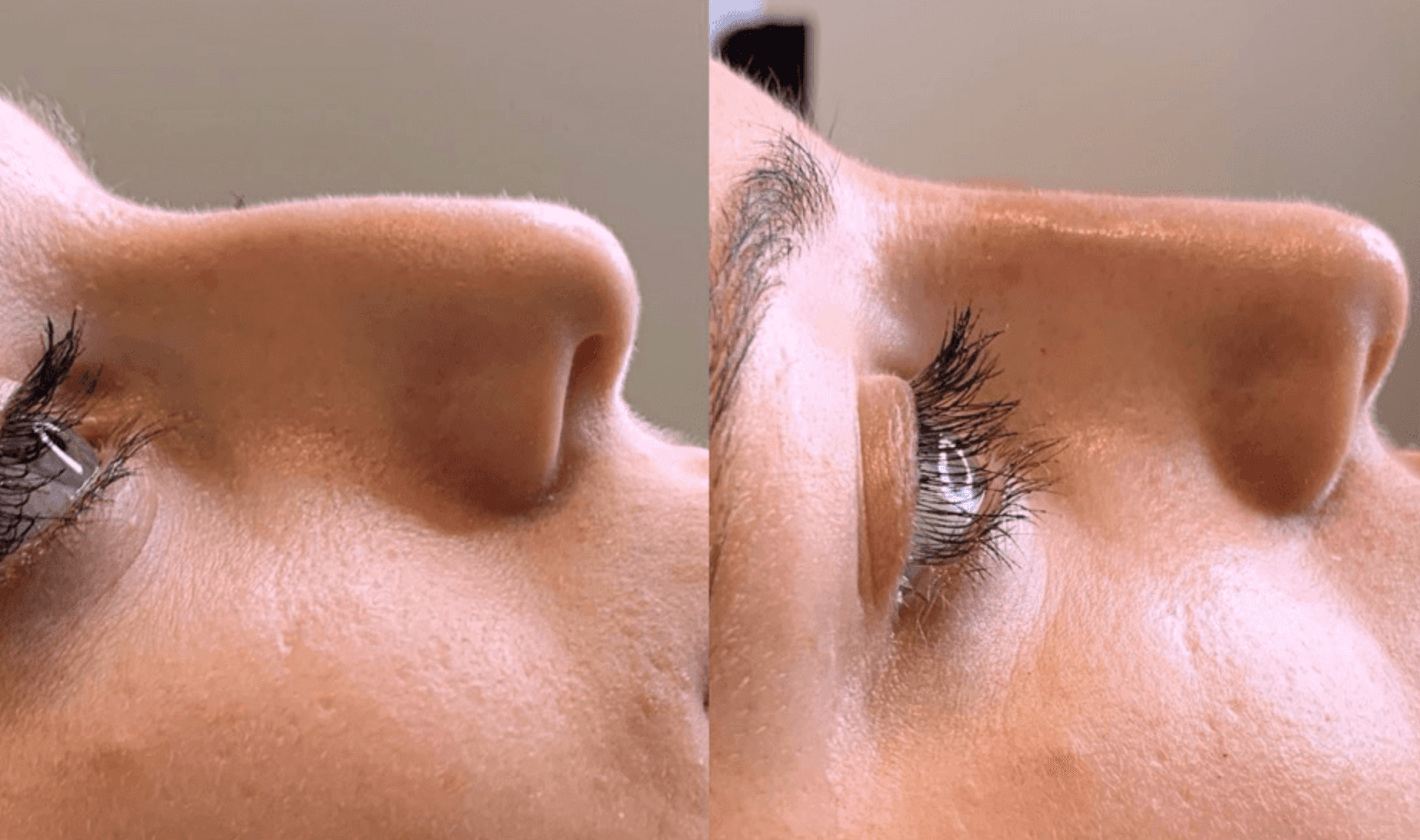 Non Surgical Rhinoplasty