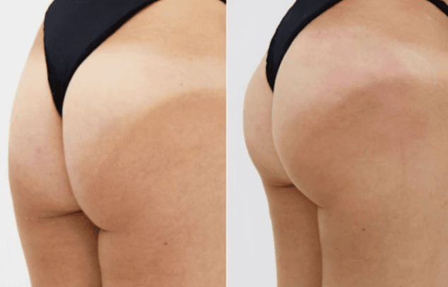 Nonsurgical Bum Lift