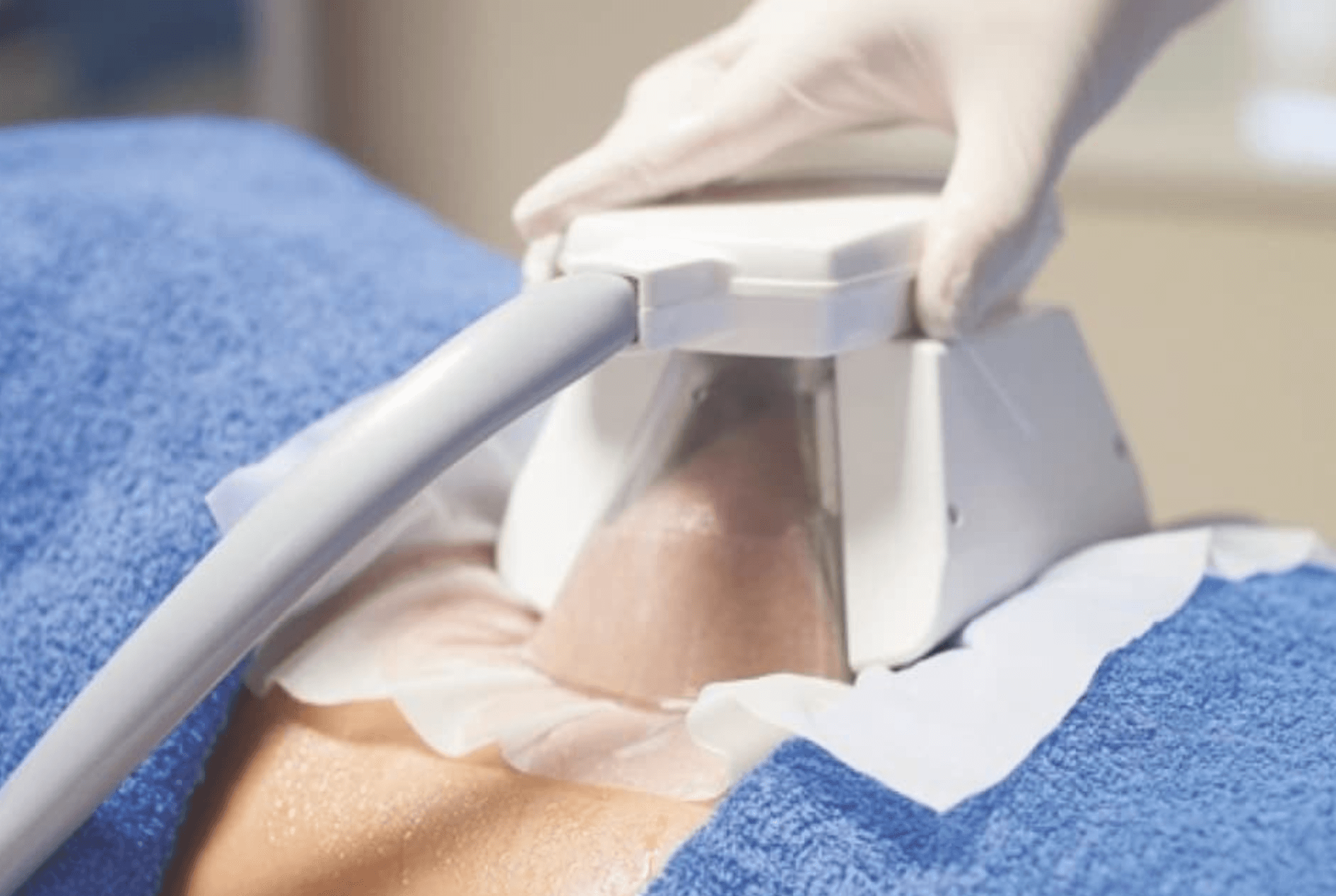 Fat Freezing - Cryolipolysis