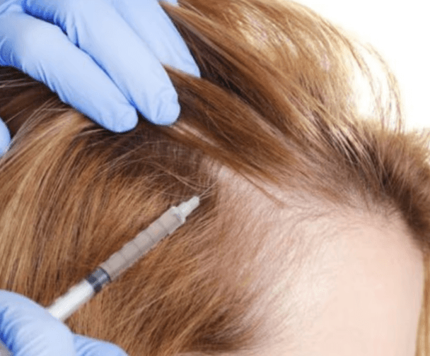 PRP Hair Treatment