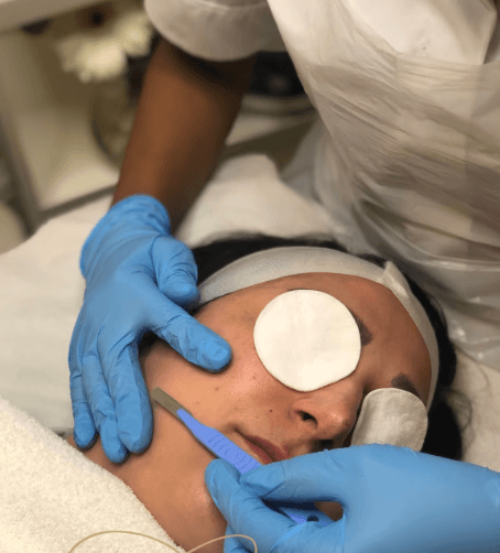 Dermaplaning