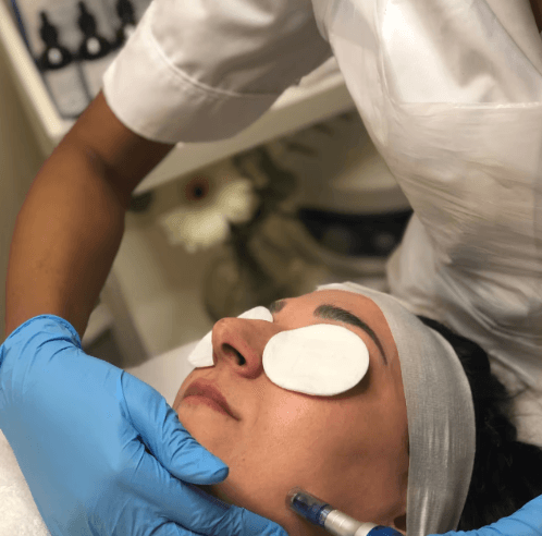 Microneedling