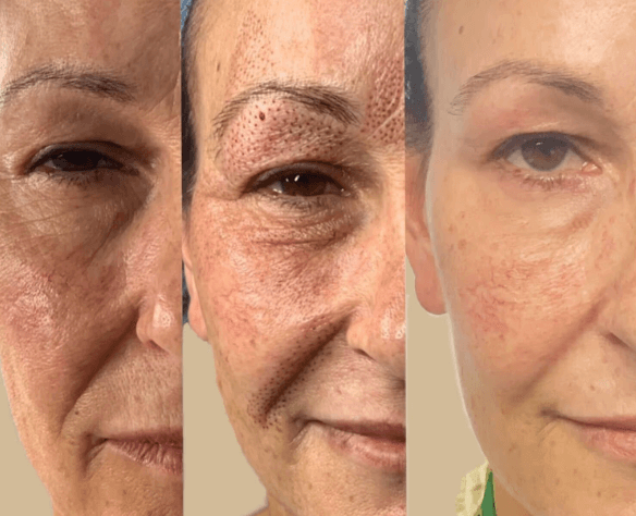 Plasma Fibroblast Skin Tightening 