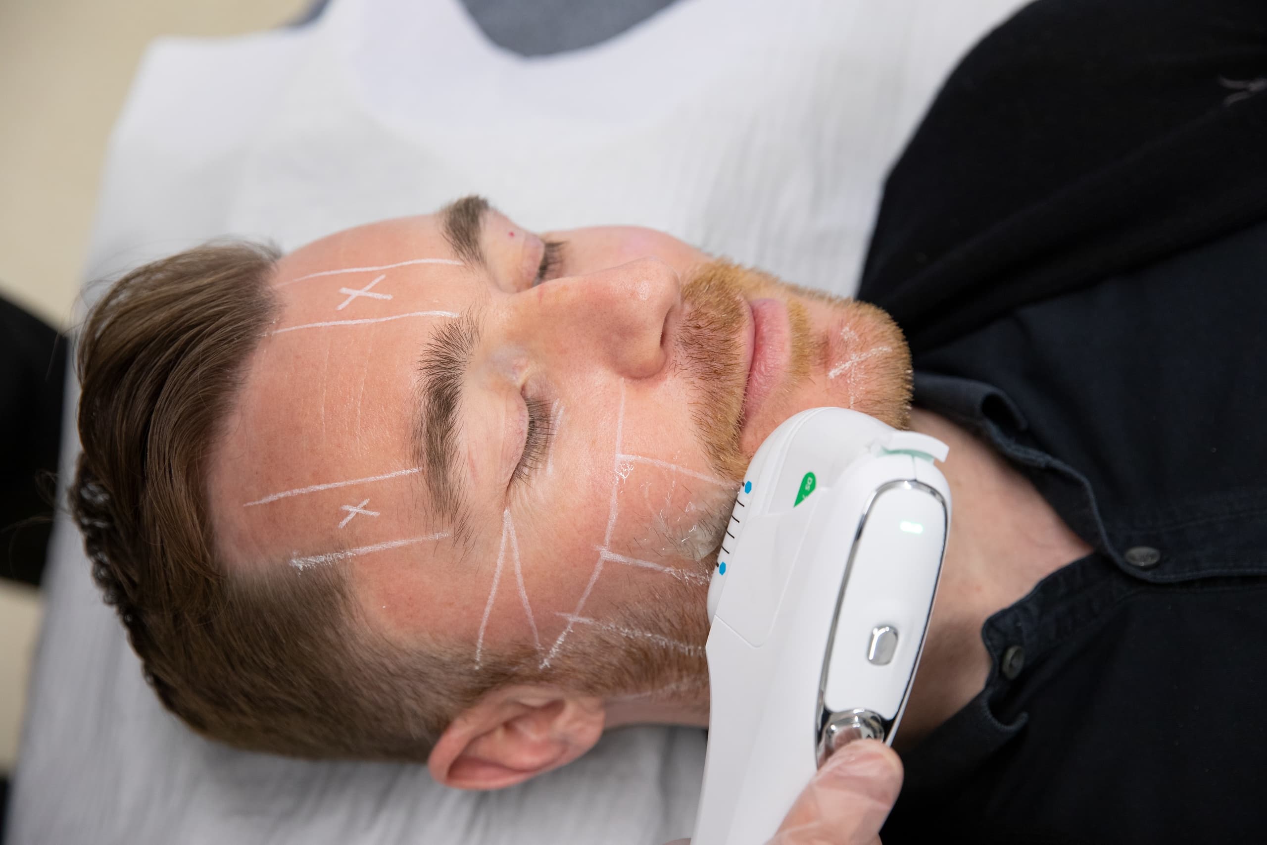 Non-surgical Skin Lifting has become one of the most sought after treatments, and HIFU is the latest to excel in this arena in just one single session!