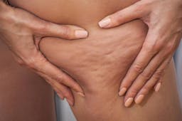 What causes unwanted clusters of cellulite to show through the skin? Is there any way to get rid of unwanted fat once and for all? Learn more today with Charmelle London