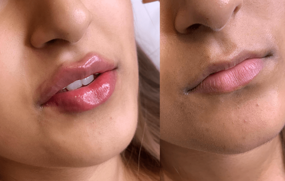 Juvederm Lip Enhancements At Charmelle London