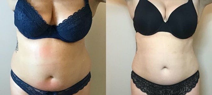 Using a Unique Combination of the latest non- surgical technologies Cryolipolysis, Body HIFU and shockwave, we can specifically sculpt and shape your most tricky stubborn areas for an overall solution