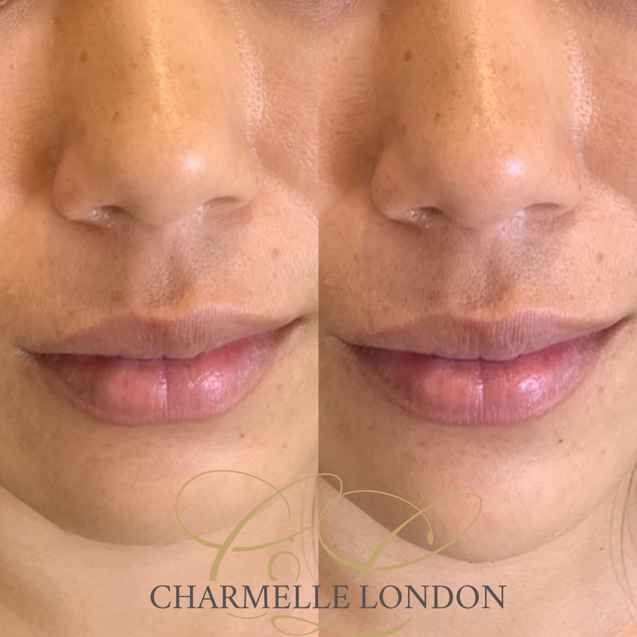 Charmelle London is one of London's leading specialists in providing subtle, natural-looking dermal filler enhancements that augment each individual’s features and introduce volume, hydration and defintion.

The passion of our specialists at Charmelle London is to deliver complete satisfaction to each and every client. Many of our clients we see routinely to keep their lips looking fabolously maintained.