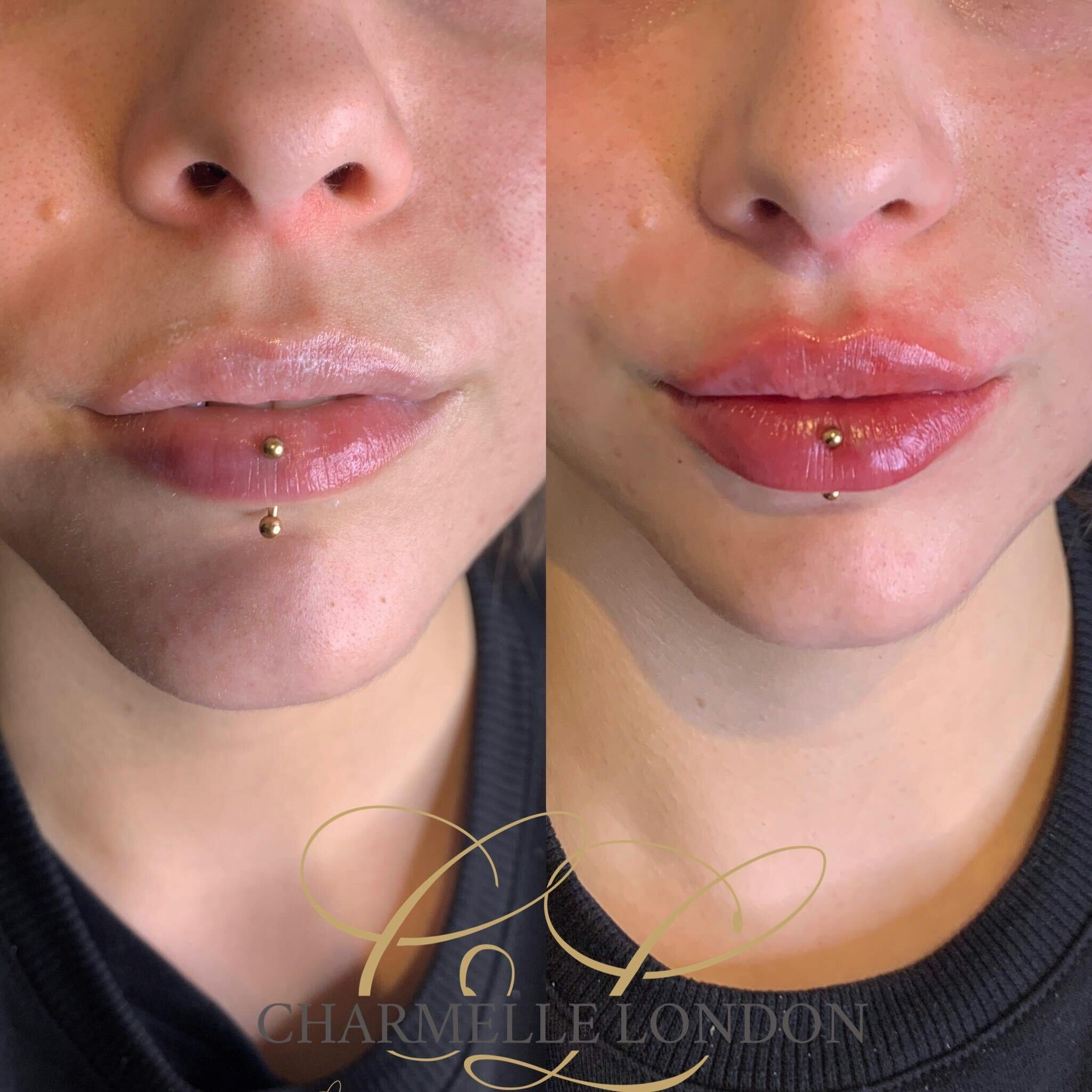 Charmelle London is one of London's leading specialists in providing subtle, natural-looking dermal filler enhancements that augment each individual’s features and introduce volume, hydration and defintion.

The passion of our specialists at Charmelle London is to deliver complete satisfaction to each and every client. Many of our clients we see routinely to keep their lips looking fabolously maintained.