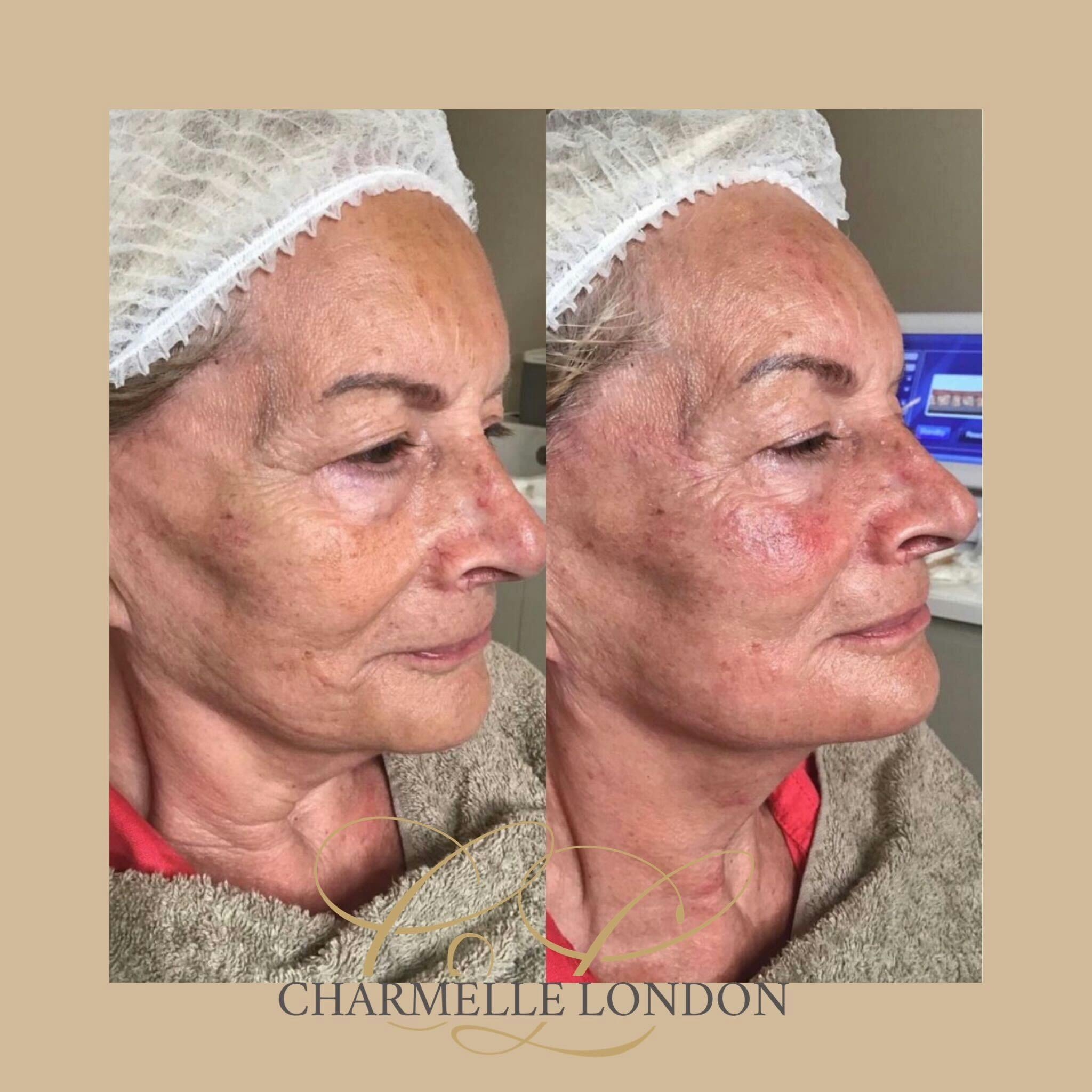 Non-surgical Skin Lifting has become one of the most sought after treatments, and HIFU is the latest to excel in this arena in just one single session!