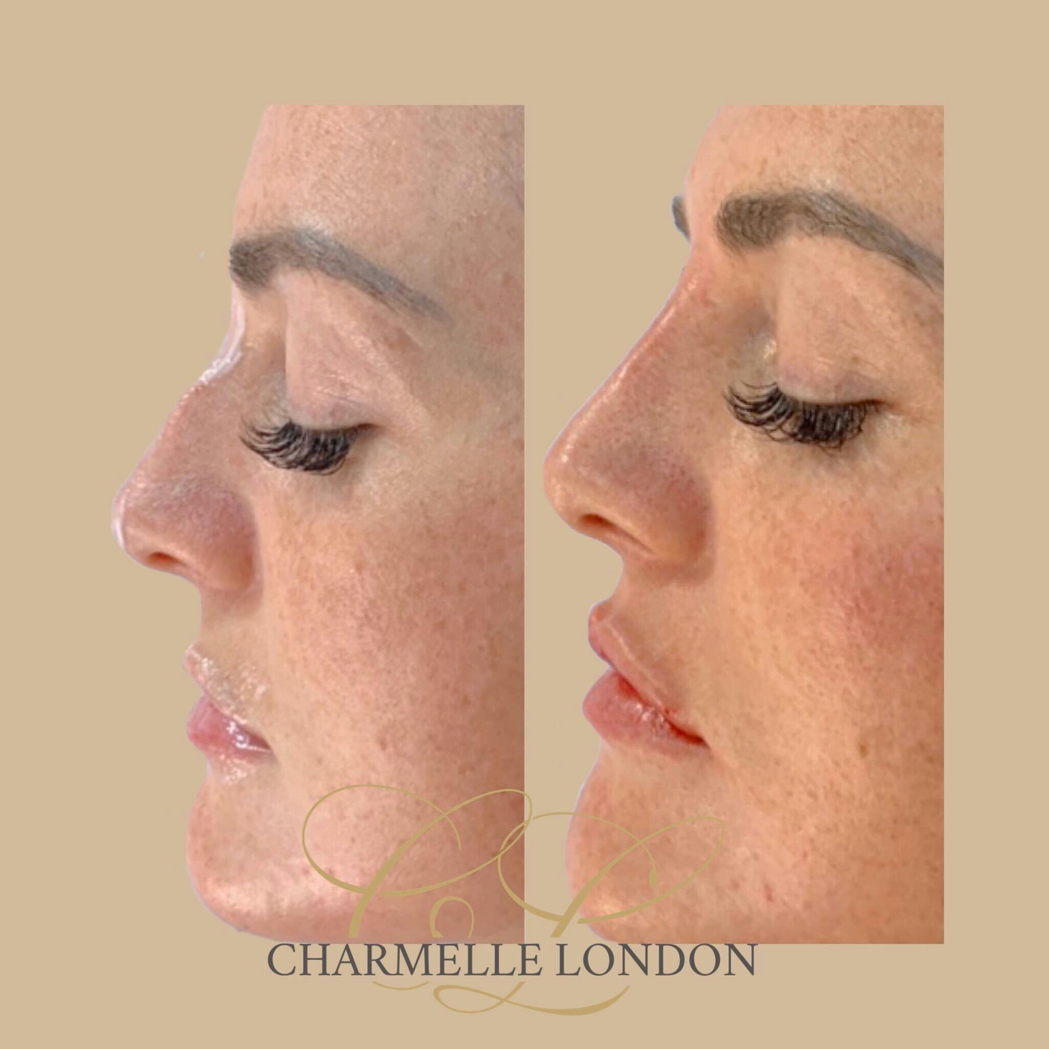 Quick and simple with instant results for people who want the change the shape of their nose without surgery.