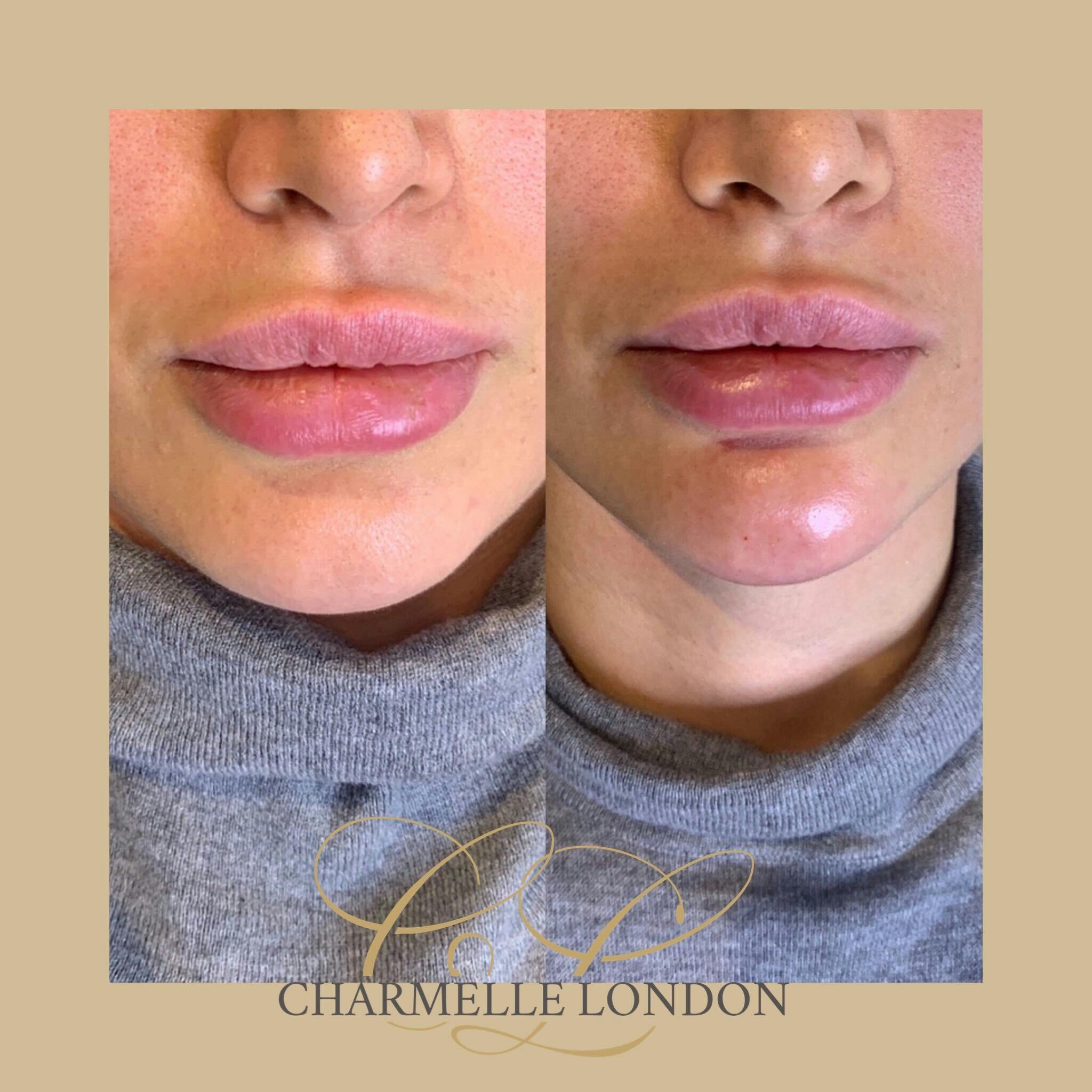 Dermal fillers work by re-shaping the chin and surrounding areas to achieve better shape, proportions and definition. As with all our treatments at the Charmelle London clinic, we aim for a natural and subtle result that suits the proportions of your face.
