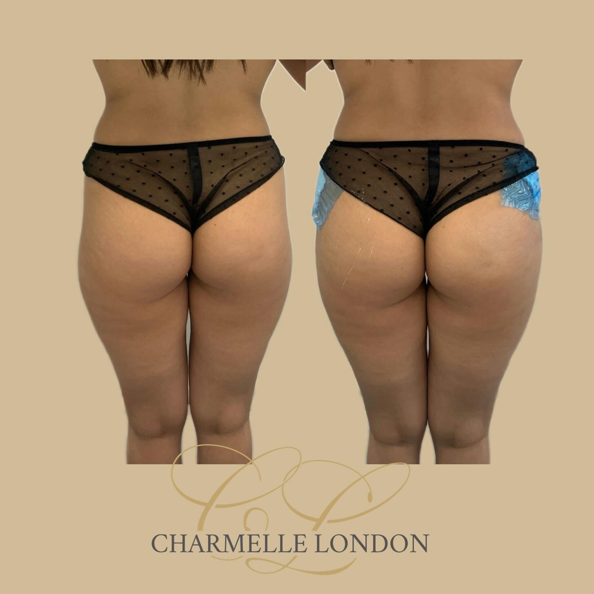  Create proportion, reshape the buttocks, add volume to the hips, and fill in hip dips. Buttock fillers are an easier way to get the buttock shape you want, without surgery.