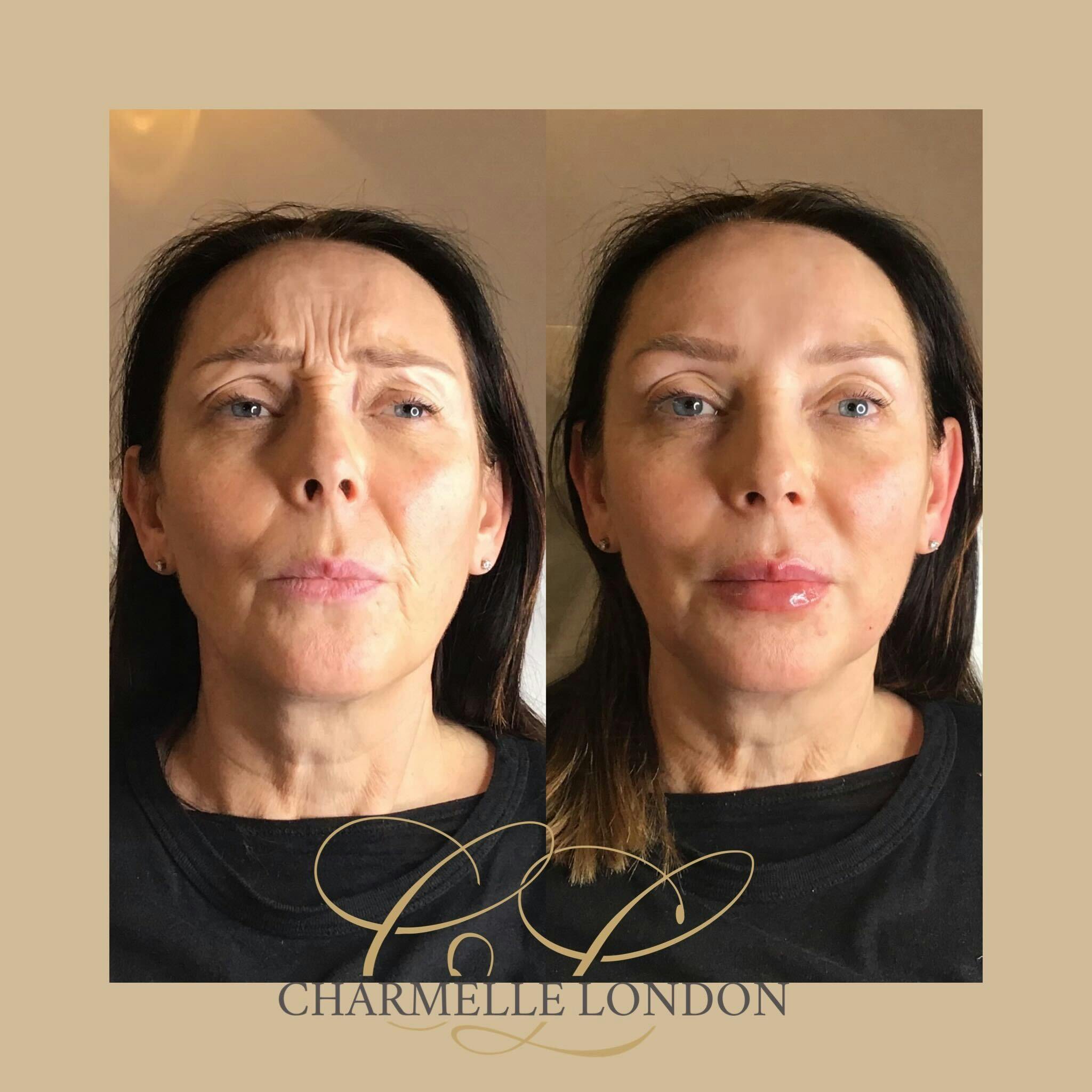 Wrinkles and fine lines aren’t just tell-tale signs of ageing; brow frowns and wrinkles around the eyes, like crow’s feet, can also make you look tired or ‘hard’.