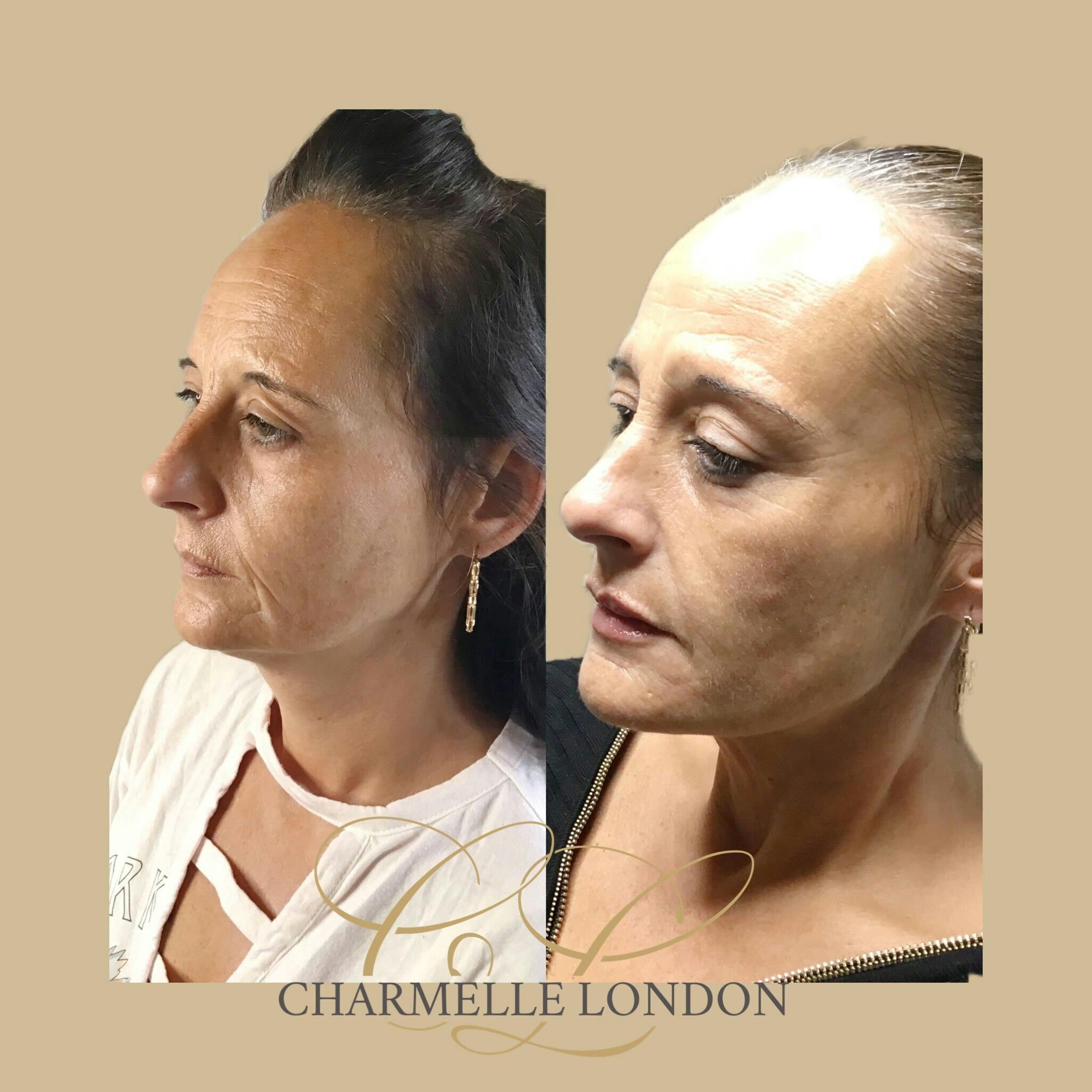 Experience emboldened confidence after receiving a skin boosting enhancement at Charmelle London. Enhance your appearance with a service dedicated to you, administered safely by experts.

With skin boosters you can rejuvenate your appearence to reveal a fresher looking you, plump fine lines and hydrate your skin.

Skin boosters are a versatile treatment option and are suitable for anyone looking to hydrate, plump and smooth their skin