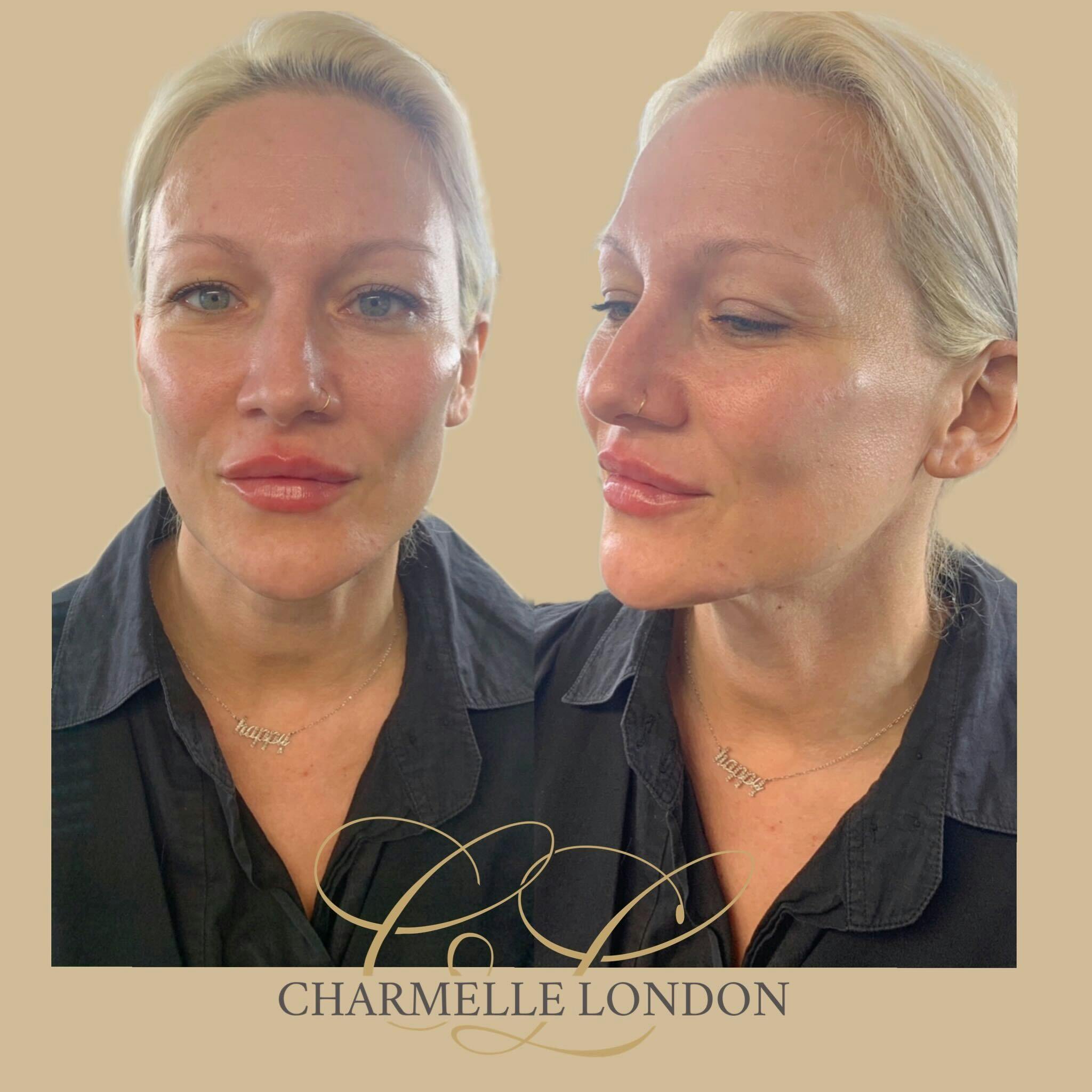 With immediate results, our bespoke facial enhancements cater to a variety of client needs and concerns. Improve the elasticity, smoothness and appearence of fine lines in your skin whilst boosting hydration and vitality. Our clients experience emboldened confidence after receiving a facial enhancement at Charmelle London.