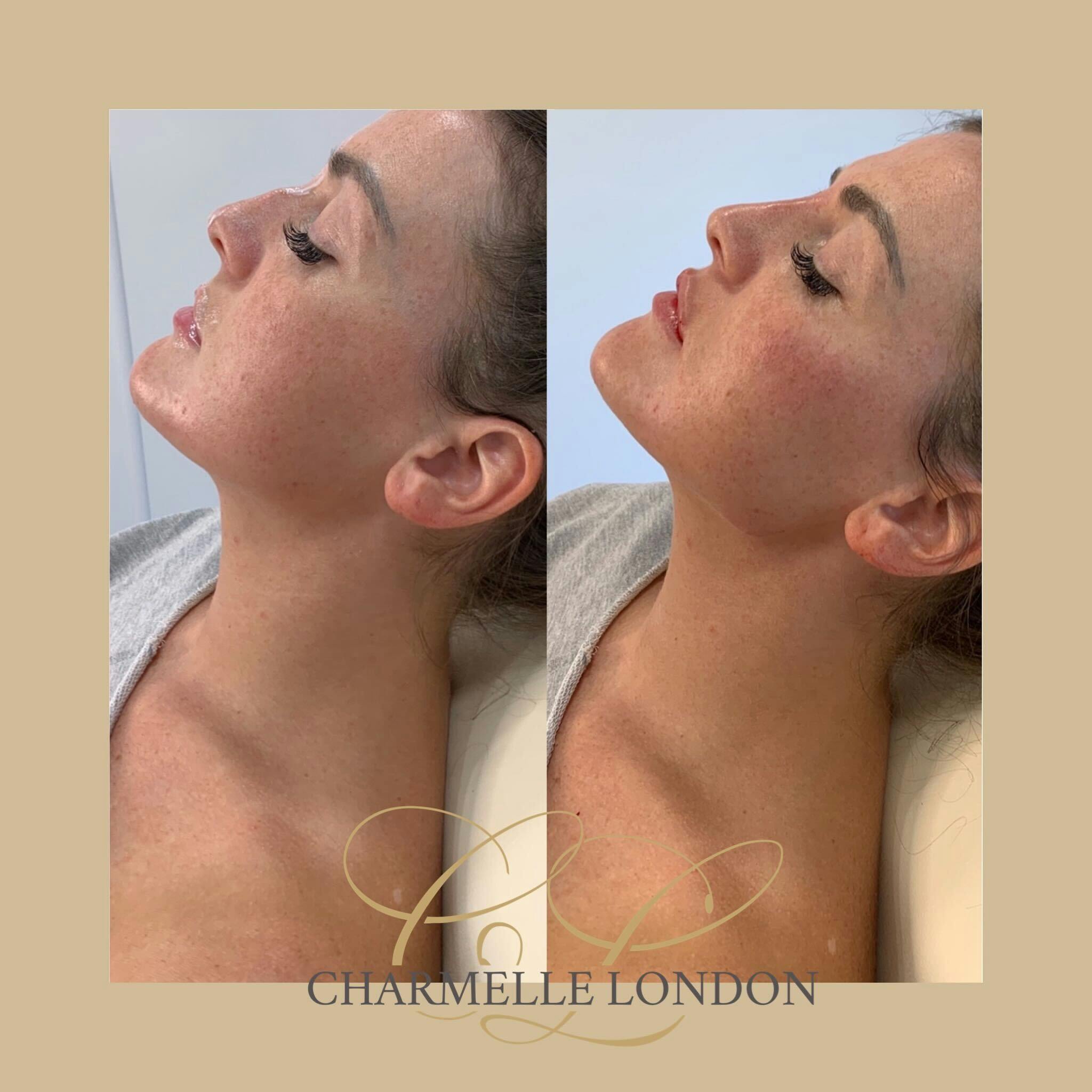 Dermal fillers work by re-shaping the jawline to achieve better shape, proportions and definition to rejuvenate your appearence to be more youthful
