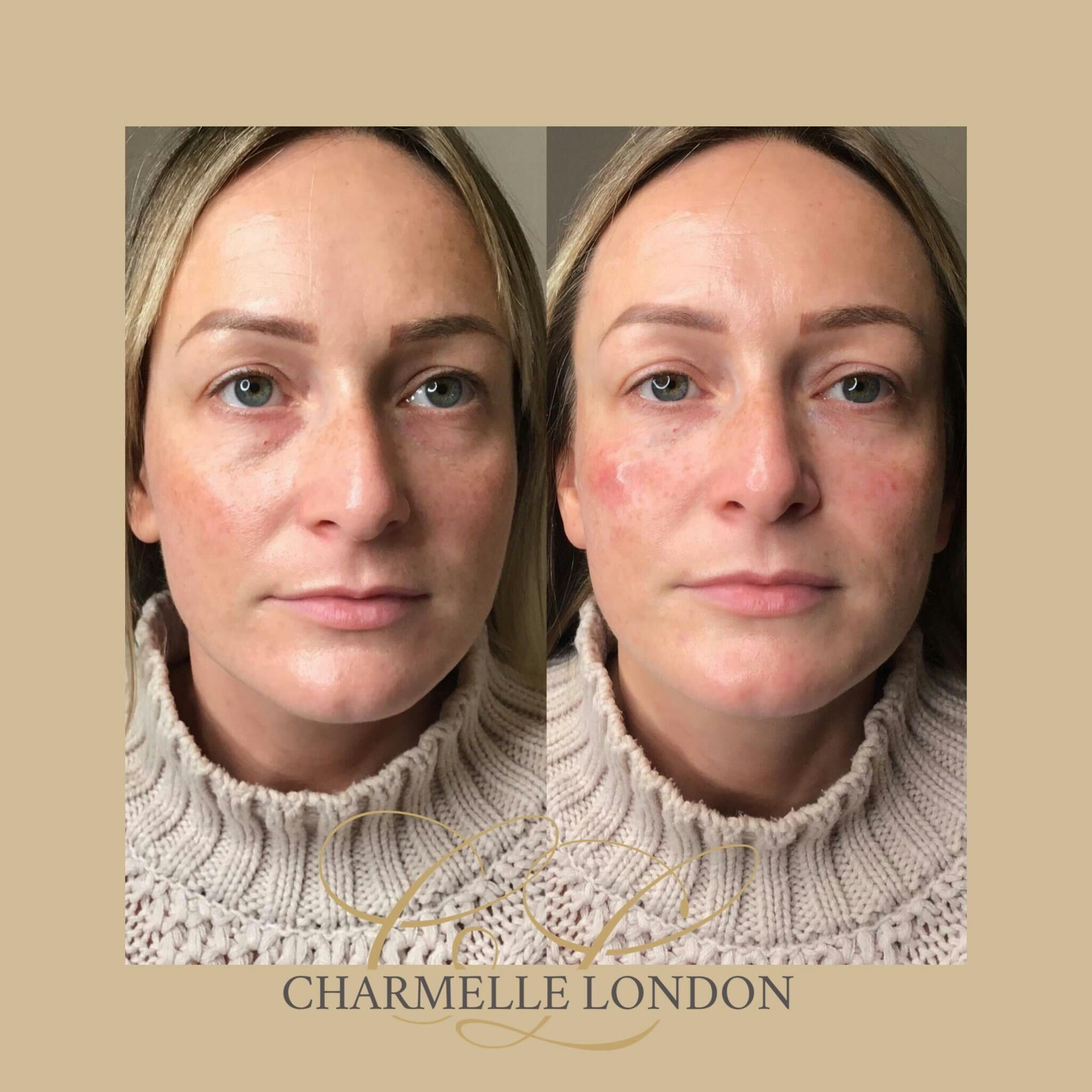 Ageing is one of the most common causes of dark circles or bags under the eyes. As we age, the fat pockets become larger, or protrude, leading to dark shadows beneath the eyes.