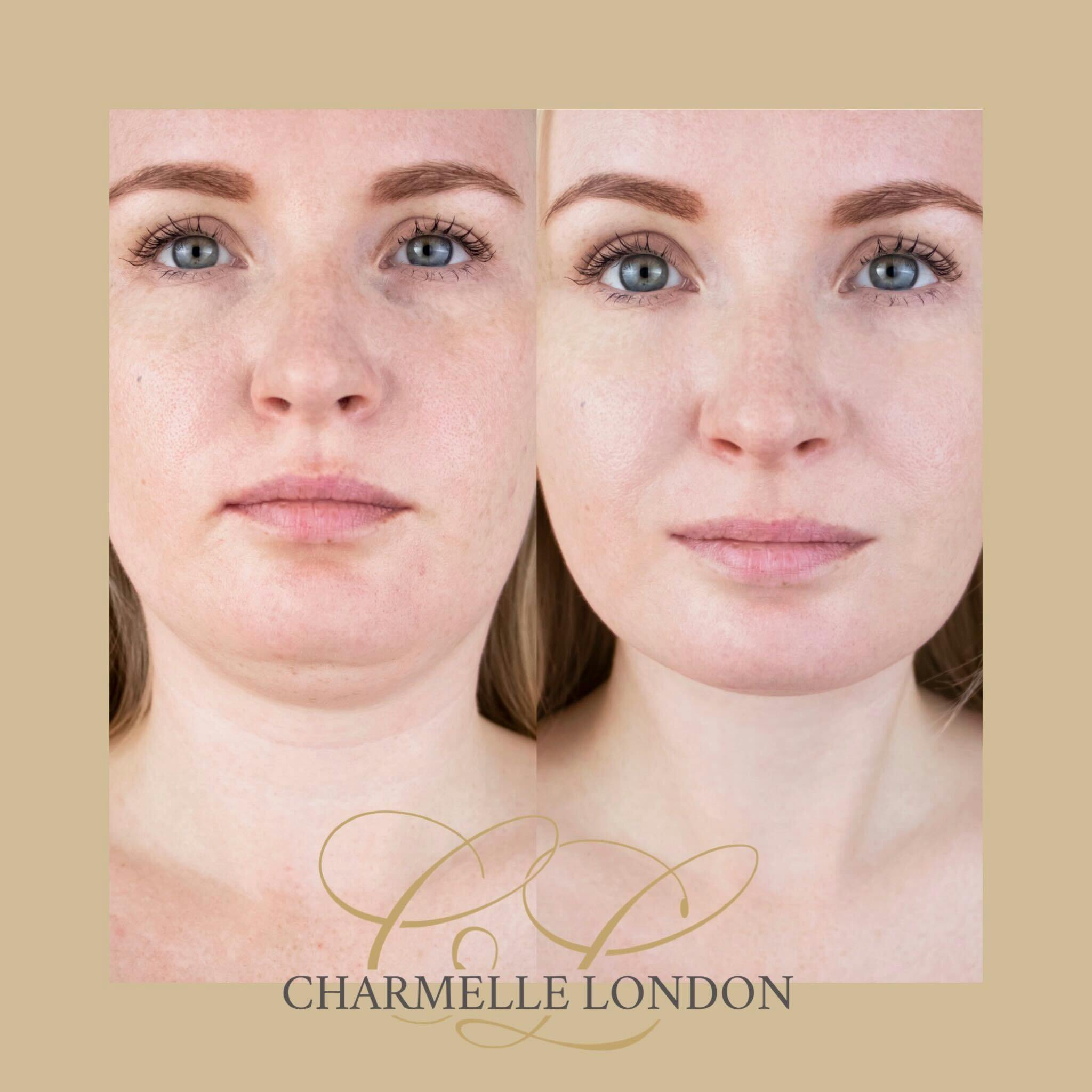 Struggling with stubborn fat that just won't budge, no matter how much you exercise or maintain a good diet? At Charmelle London, we offer Aqualyx Fat Dissolving Injections, a popular and effective body sculpting treatment that targets and eliminates stubborn fat in problem areas.