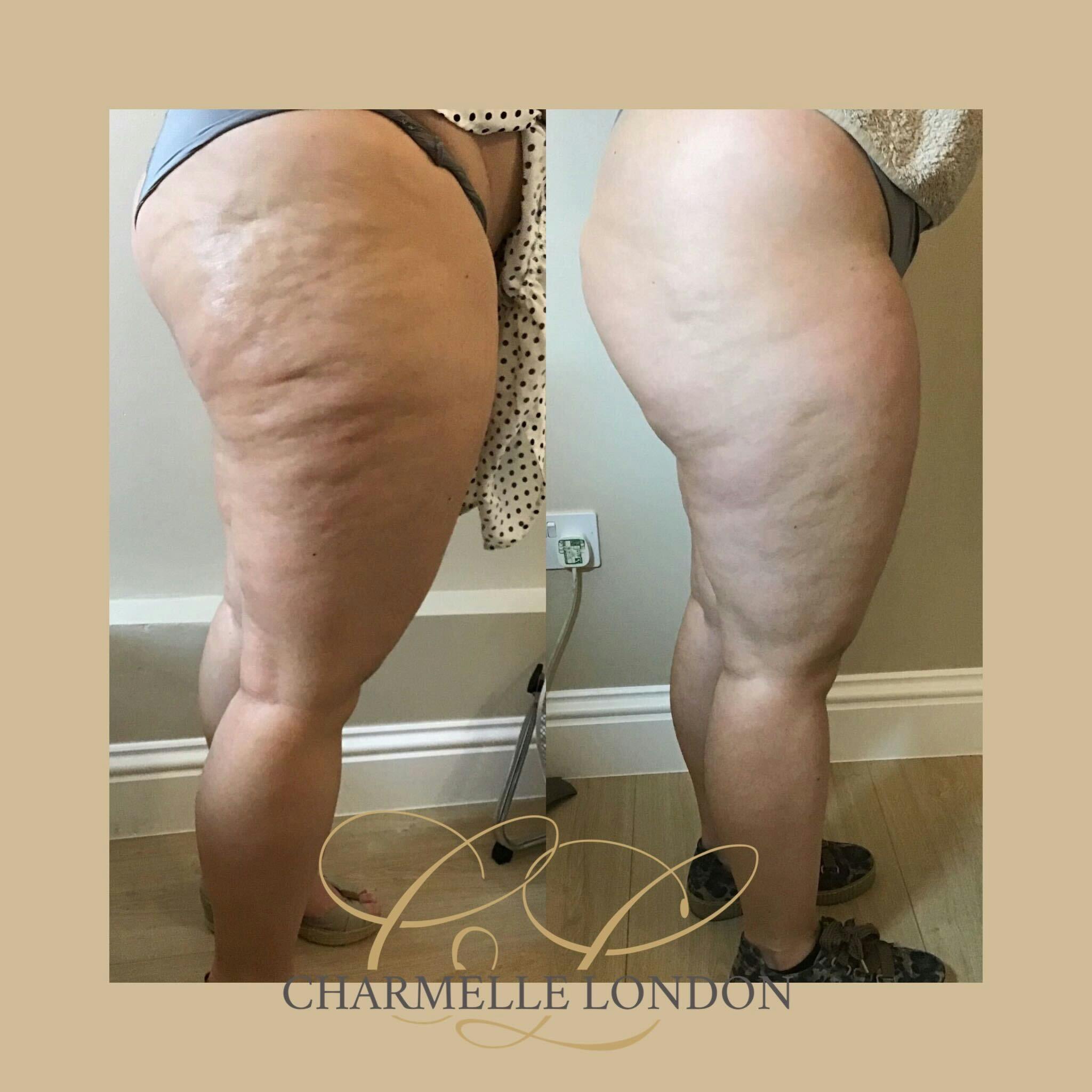 A prescriptive treatment tailored to meet your needs using a combination of 3D Shockwave and 3D radiofrequency is used to reduce cellulite.