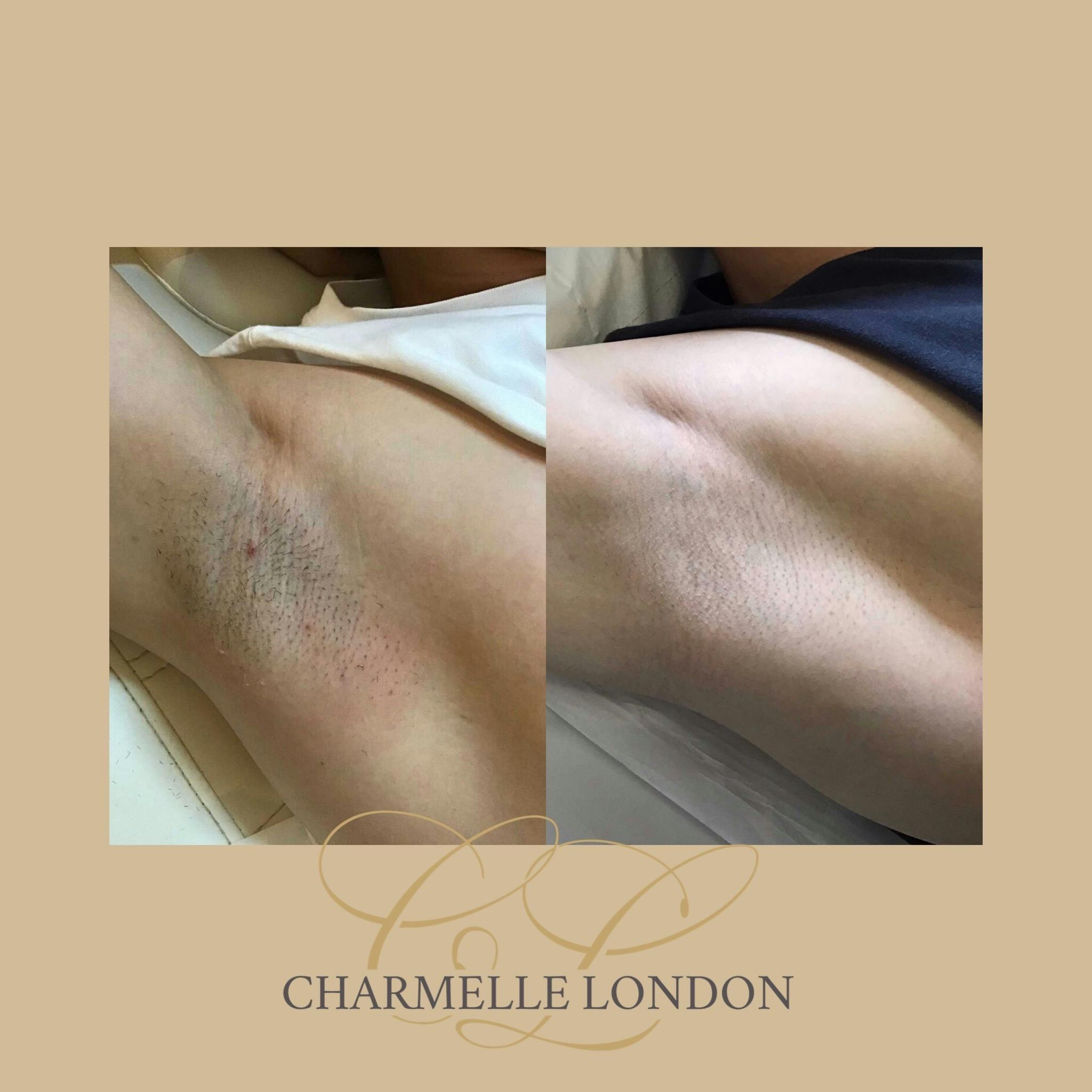 Laser Hair Removal Experience the ultimate in hair removal with our medical-grade Laser Hair Removal treatment. Suitable for all skin types, it delivers long-lasting results with no downtime. Book your session today at Charmelle London.