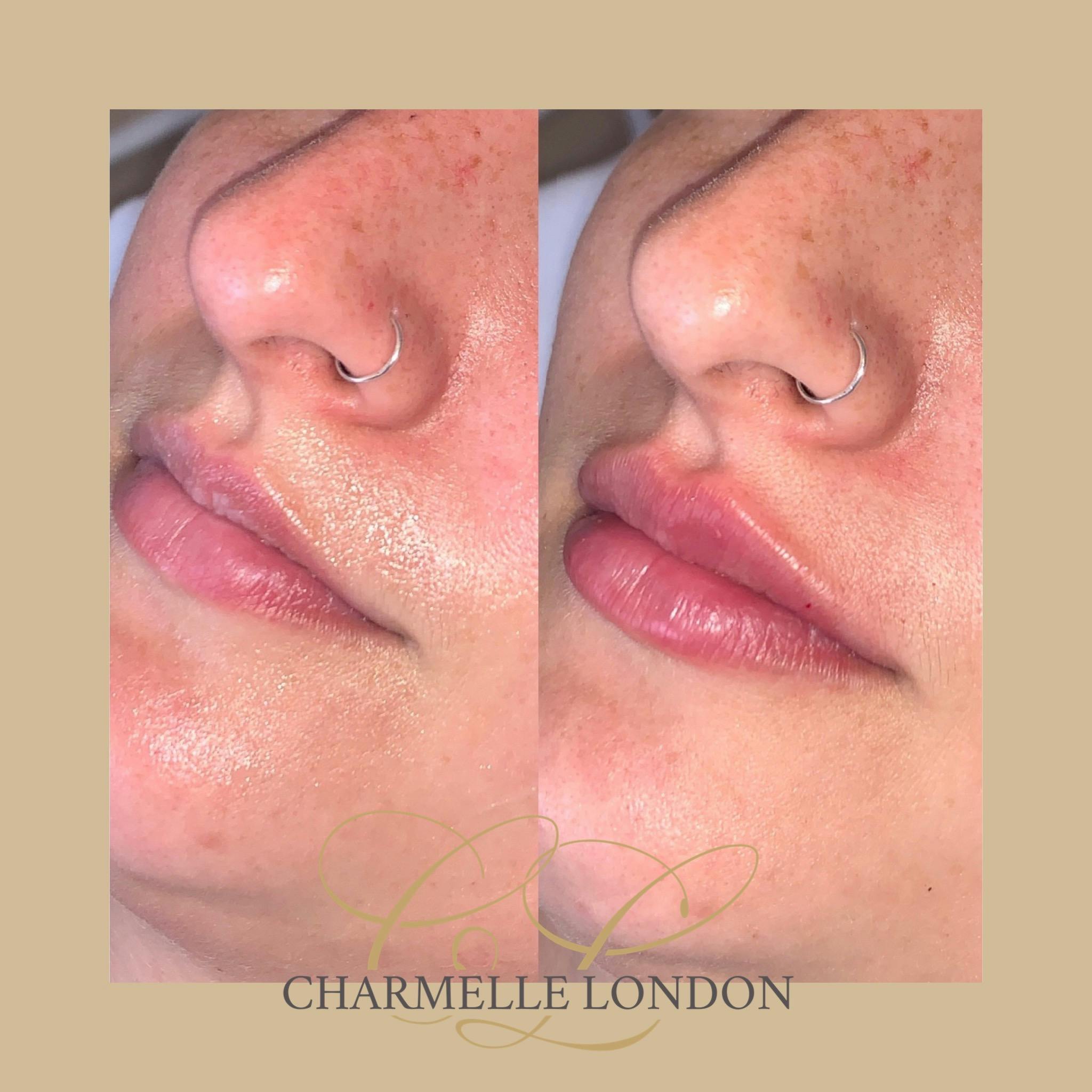 Lips are an important part of facial beauty and can add appeal and youth to a face when they are well balanced with other facial features. Lip fillers can be used to plump, enhance or reshape thin or ageing lips with natural yet transforming results.