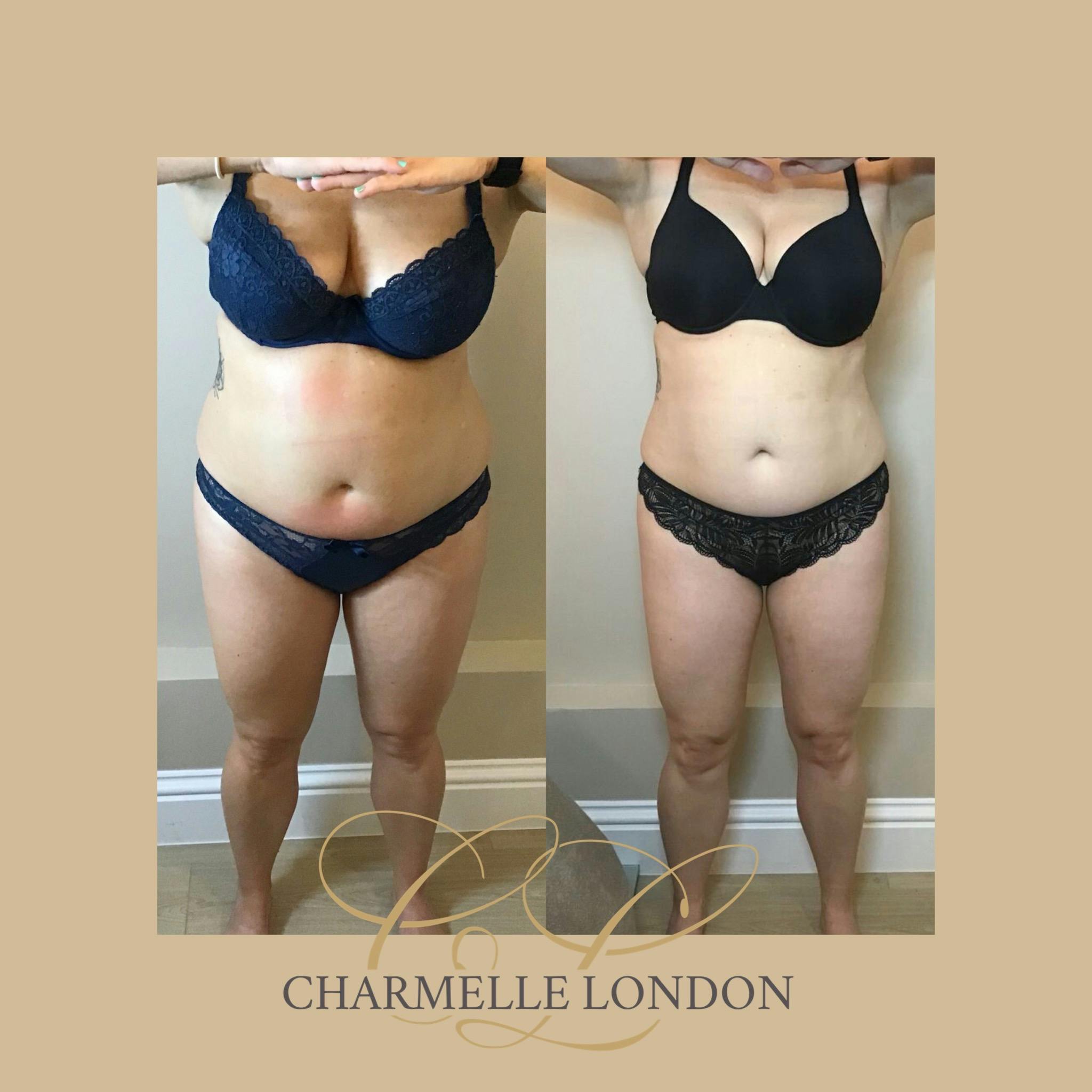 3D 5 Point Lift Using a Unique Combination of the latest non- surgical technologies Cryolipolysis, Body HIFU and shockwave, we can specifically sculpt and shape your most tricky stubborn areas for an overall solution. Call 0333 016 3500.