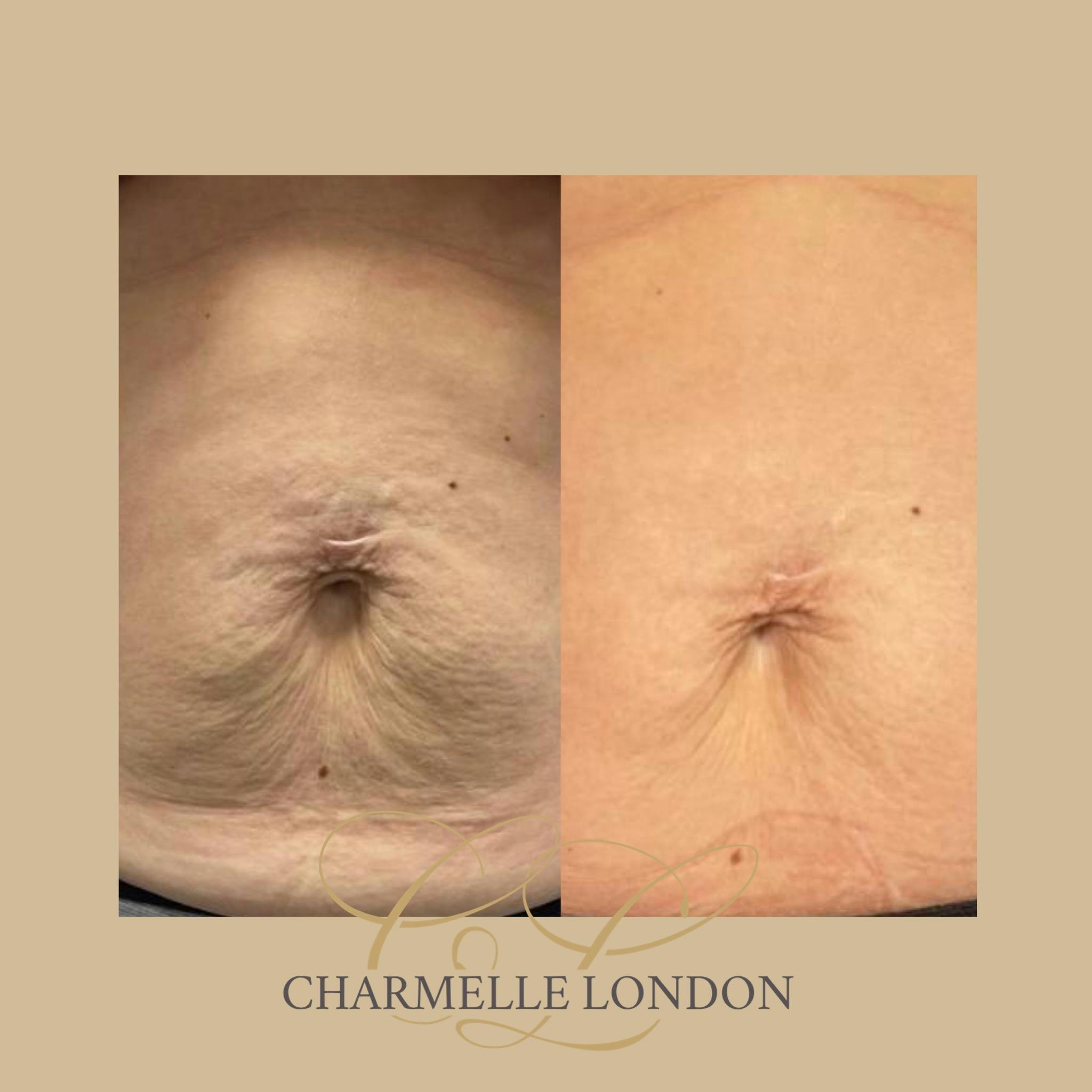 A revolutionary new non-surgical, cosmetic procedure that works completely with the body’s own natural regeneration process. It has a proven model of action, with good clinical outcomes and safety profile, resulting in brighter, healthier, more youthful-looking skin.