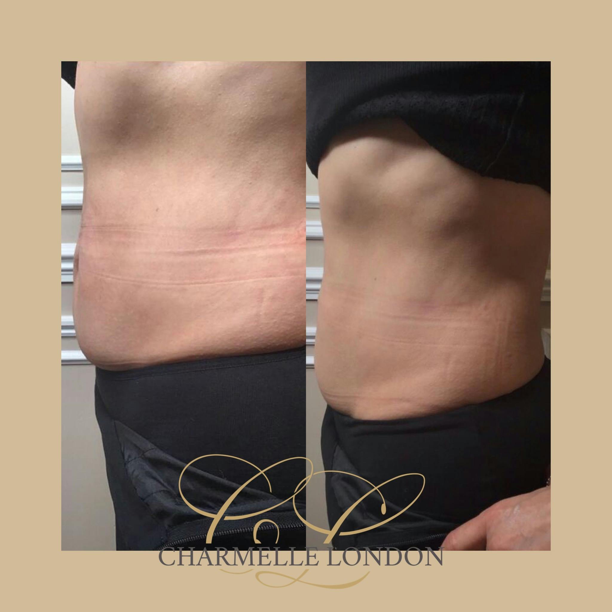 Ultimate HIFU Body 3D Body HIFU (High Intensity Focused Ultrasound) is used for body sculpting, and to treat stubborn pockets of fat in the fastest possible treatment time. Call 0333 016 3500.