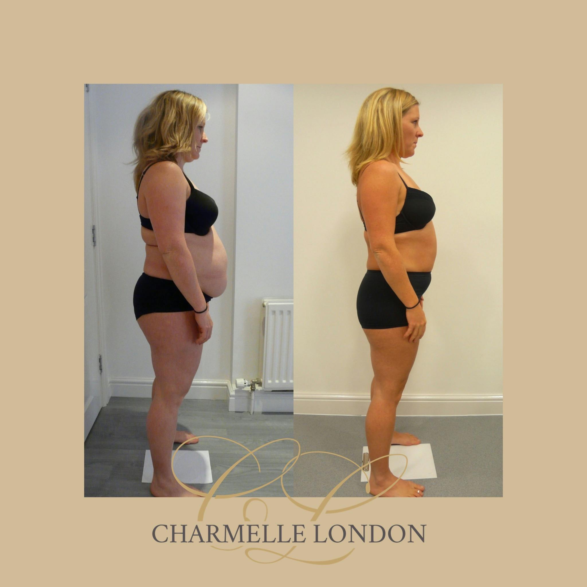 3D Bespoke Concentrated Non Surgical Fat Removal Expert treatment which involves an individual or combined bespoke treatment using 3D-Cavitation, 3D-Radio Frequency and/or 3D-Shockwave. This creates a complete, effective and safe choice for fat reduction. Call 0333 016 3500.