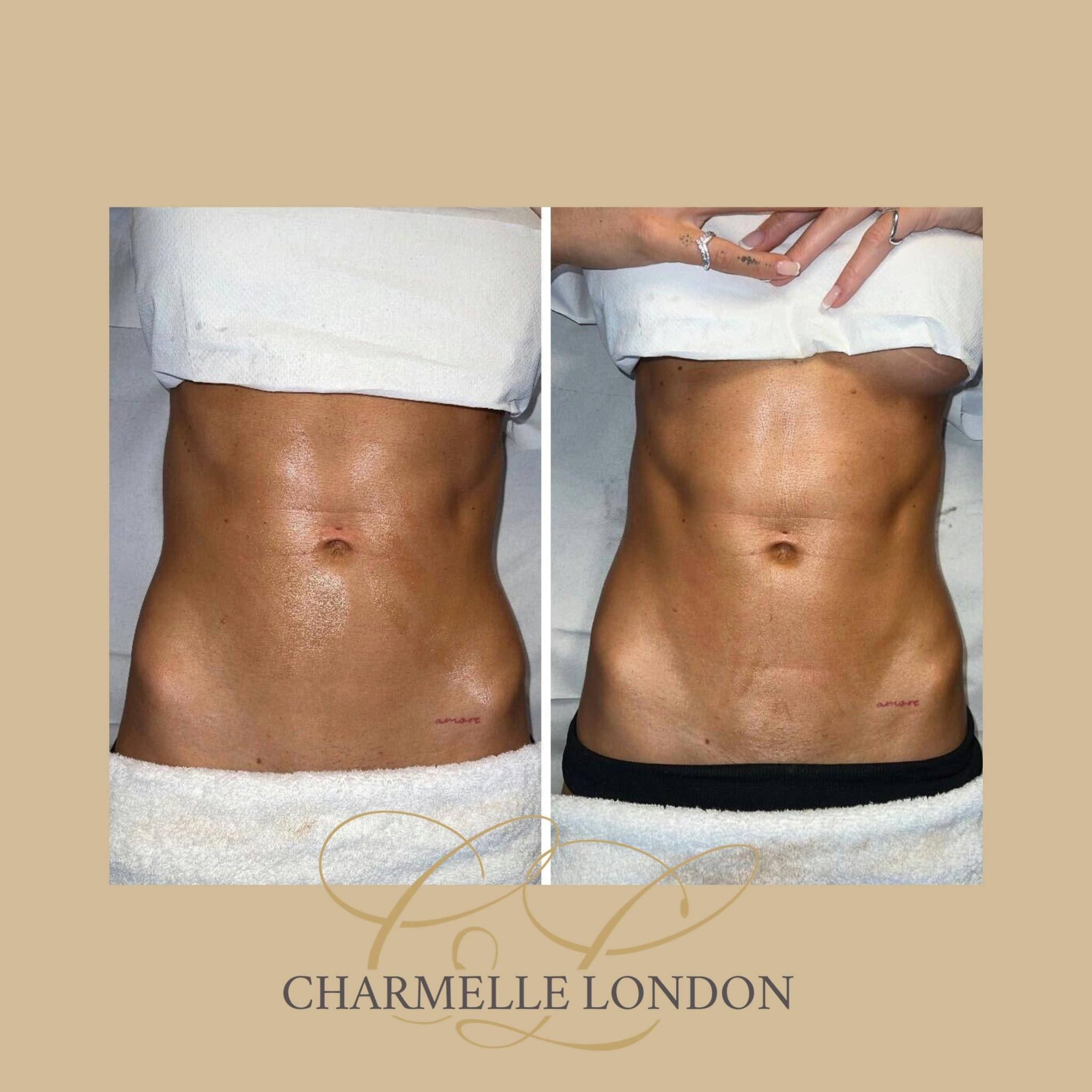 This treatment involves an individual or combined bespoke treatment using 3D-Cavitation, 3D-Radio Frequency, 3D-Shockwave and manual lymphatic massage